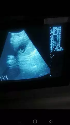 3、怀孕12周胎儿彩超图，有哪位宝妈是有这个图的啊，可以发给我参考下吗？