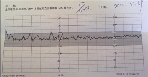 2、胎心监护如何看男女 看男女的方法