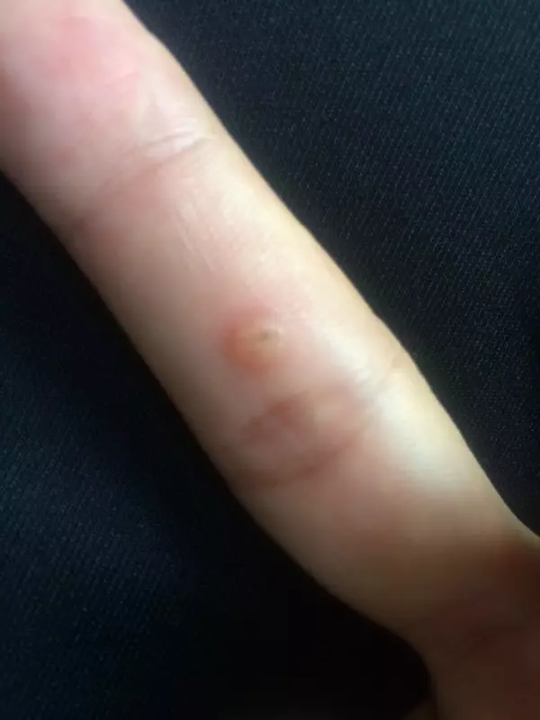 4、手指有小水泡是癌症的前兆吗？