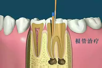 3、牙根尖炎巳做根管**一年了多次换药还不行应怎办