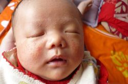婴儿湿疹最佳治疗方法 这么做可有效预防婴儿湿疹哦