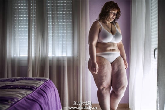 120公斤胖妹做胃绕道减肥手术暴减50公斤恢复自信